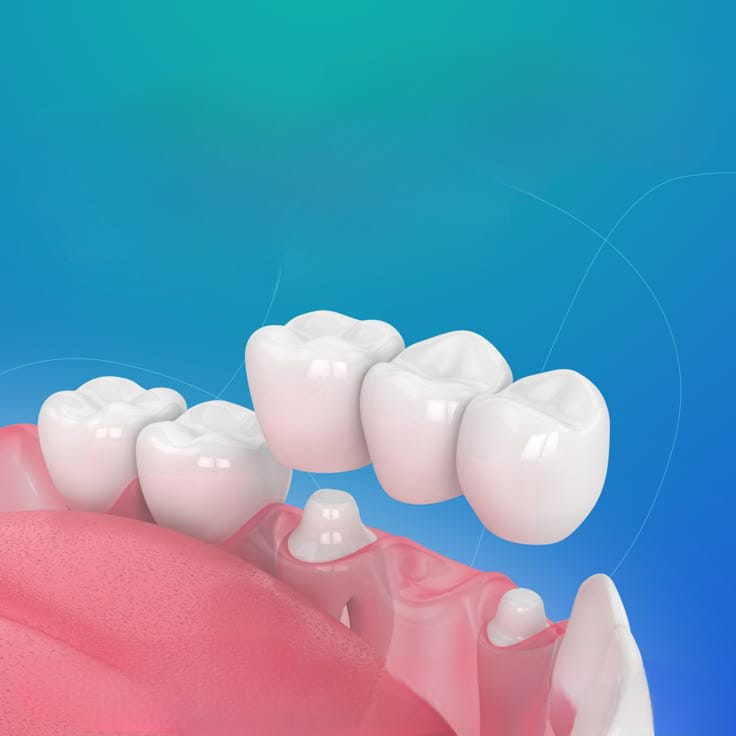 Dentures, Crowns & Bridges